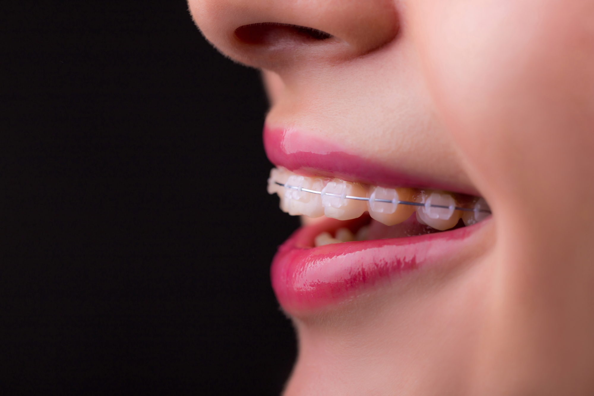 Ko je ortodont na vrsti, da sname zobni aparat, je dan res lepši