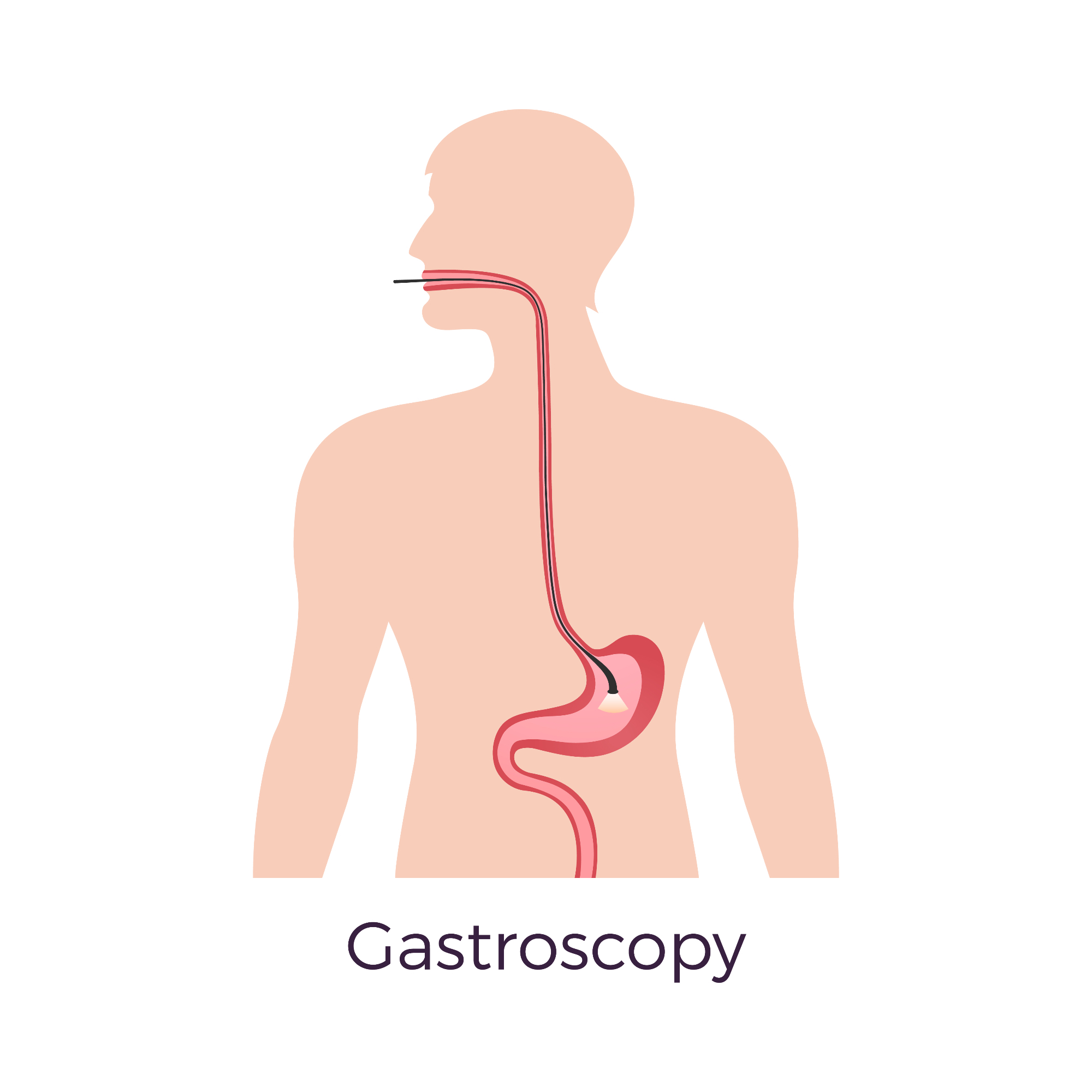 Kaj je gastroskopija in zakaj je pomembna?